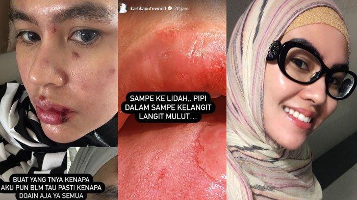 Curhat Kartika Putri Alami Penyakit Misterius, Sedih Wajah dan Lidah Melepuh Tanpa Sebab