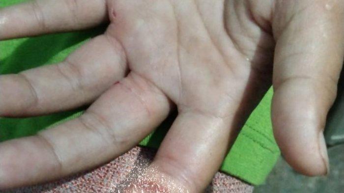 Jari bocah perempuan di Kuningan nyaris putus di gergaji sang ayah.