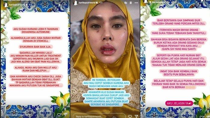Kartika Putri mengungkapkan awal mula wajah dan bibirnya mengalami luka melepuh.