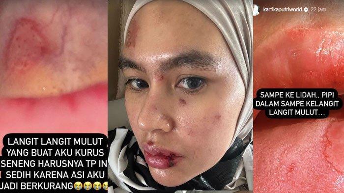 Kondisi Terkini Kartika Putri, Akui Sedih ASInya Berkurang Imbas Derita Penyakit Misterius