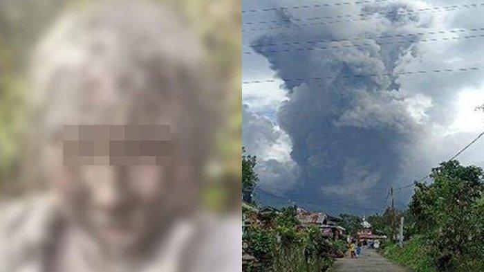 Kondisi terkini Zhafirah Zahrim Febriana mahasiswi yang terjebak erupsi Gunung Marapi, Sumatera Barat.