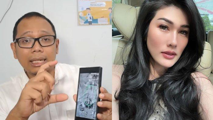 Penjelasan Dokter Soal Benda Asing di Rontgen Stevie Agnecya, Heboh Diduga Meninggal Karena Santet