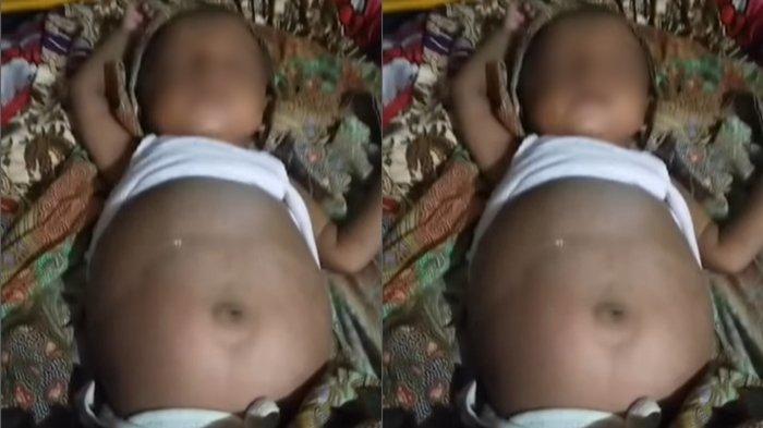 Viral Bayi Laki-Laki di Sumbar Hamil, Kondisi Janin Hidup, Ternyata Saudara Kembarnya, Nasibnya Kini