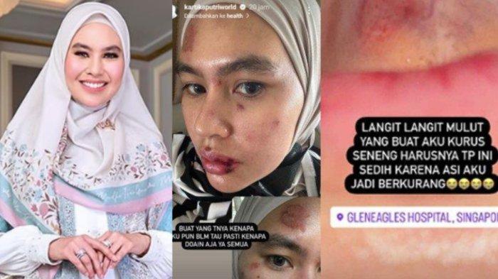Kartika Putri secara misterius alami luka melepuh di wajah dan mulut.