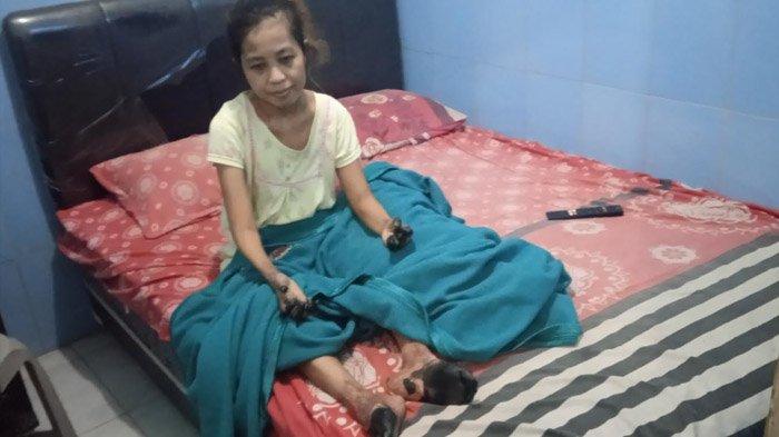Kondisi Septia Kurnia Rini, TKW Jember yang tangan dan kakinya menghitam usai operasi di Singapura.