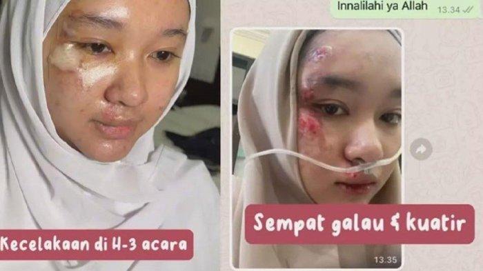 Calon pengantin kecelakaan jelang hari pernikahan, untung bisa ditutup make up