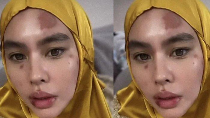 Kartika Putri Pernah Dihujat Saat Tantang Capres Ngaji, Kini Idap Autoimun, Wajah dan Lidah Melepuh