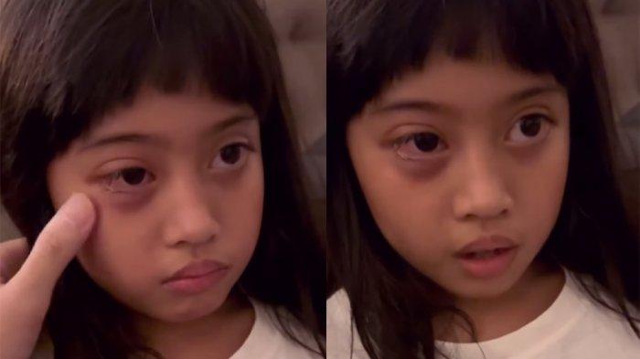 Kondisi Vania Athabina adik Verrel Bramasta jadi korban bully di sekolah
