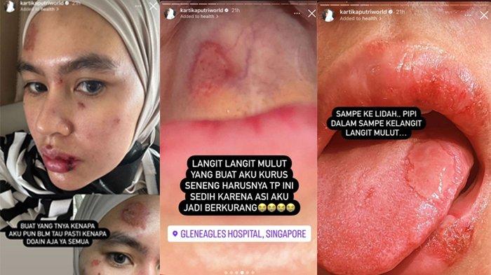 Kondisi luka di wajah dan lidah Kartika Putri