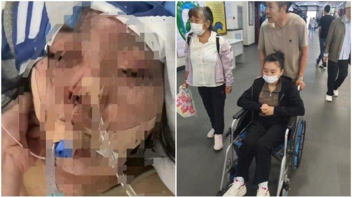 Korban KDRT Lao Chunxue (28) dari Mongolia Dalam di China utara. (Baidu)