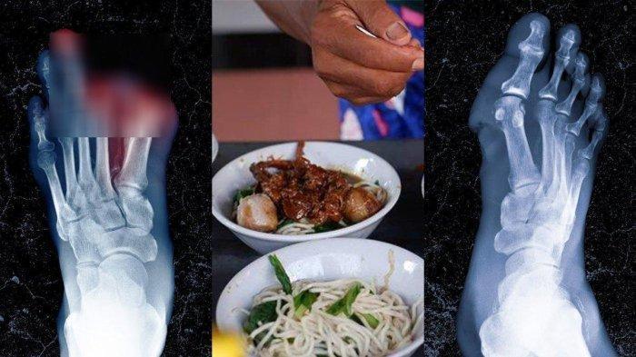 Nasib Mahasiswa Jarinya Diamputasi Setelah Makan Mi Ayam Sisa Teman,