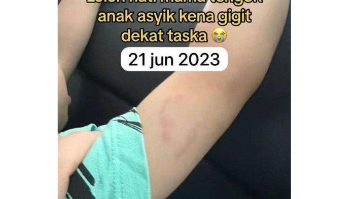 Selain wajah, bagian tangan juga digigit