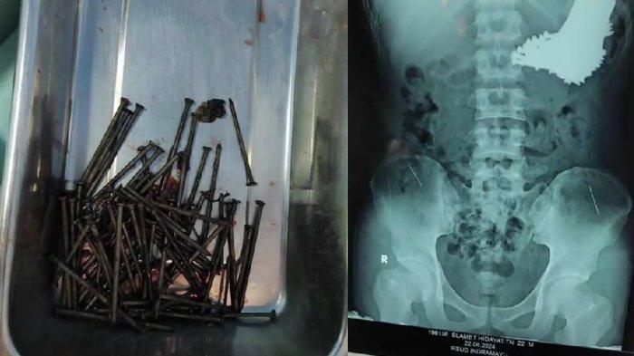 Sosok Slamet di Perutnya Ada 70 Paku dan Jarum, Bukan Disantet, Dokter Bongkar Penyebabnya