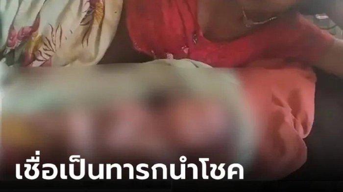 Tim Dokter Ketakutan Bantu Lahiran Bayi dengan 2 Wajah dan 8 Anggota Badan, Ayah Anggap Keajaiban