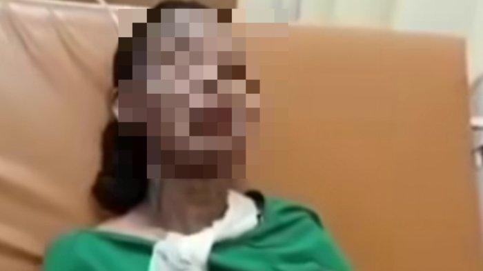 Istri yang dibakar suaminya di Cakung, Jakarta Timur karena cemburu mendapat perawatan di rumah sakit.