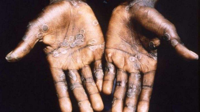 Ilustrasi sakit Cacar monyet atau monkeypox.