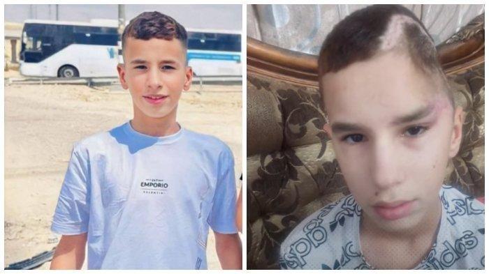 Abdul Rahman (14), tahanan Palestina yang dibebaskan oleh Israel pada Rabu (28/11/2023) dalam kesepakatan pertukaran sandera dan tahanan dengan kelompok bersenjata Hamas Palestina. Abdul Rahman kehilangan separuh tengkoraknya karena ditemak 30 kali oleh Israel sekitar 3 bulan lalu.
