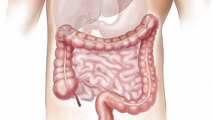 SERAMBIBINEWS.COM - Harus tahu, ternyata tiga jenis makanan yang biasa dikonsumsi ini bisa sebabkan kanker usus besar.