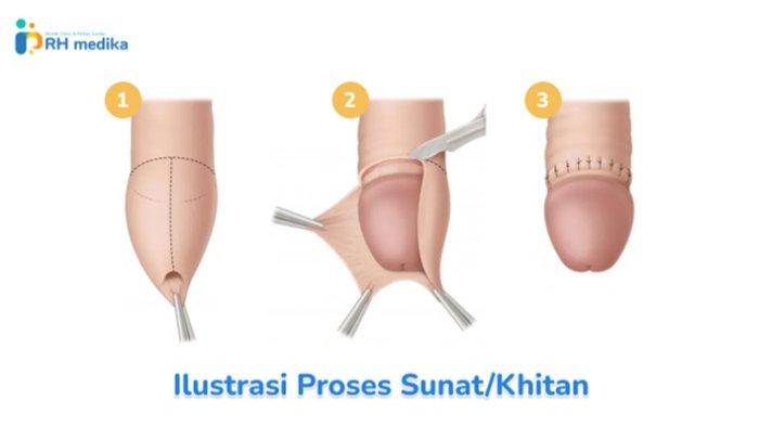 Ilustrasi Sunat dan Ilustrasi Khitan