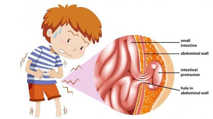 Berita Hernia Inguinalis Terbaru Hari Ini - Serambinews.com
