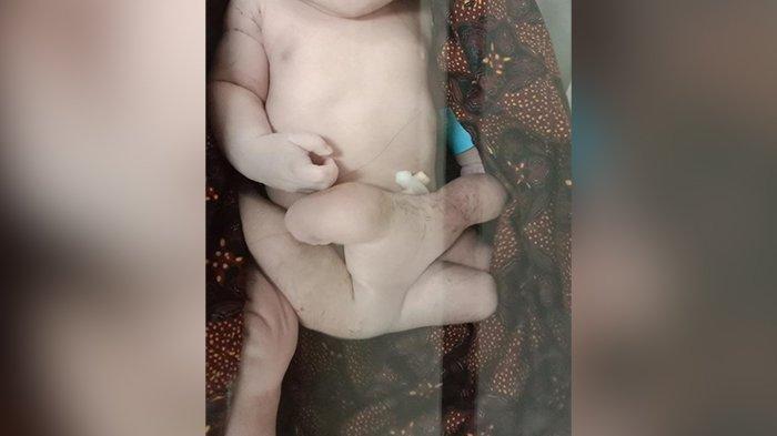 Kondisi bayi kembar siam bayi kaki enam dari Suangi, Kecamatan Sekotong, Lombok Timur. RSUD Provinsi NTB telah berkoordinasi dengan RSUD Dr. Soetomo Surabaya untuk penanganan pascaoperasi. /Foto: Istimewa