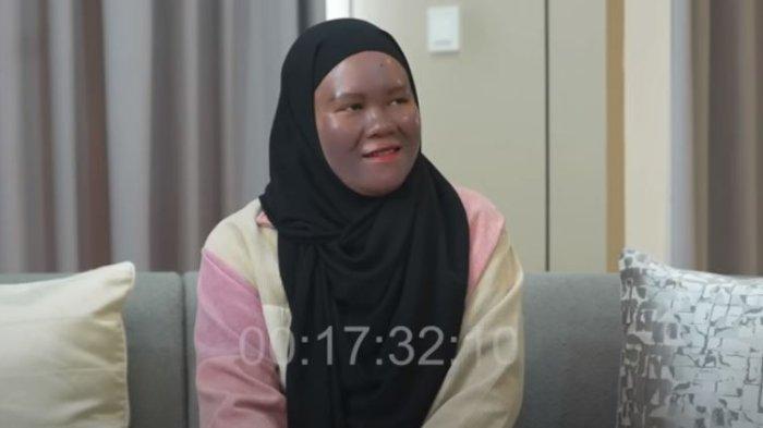 Viral Kisah Wanita Ini Alami Wajah Gosong Gegara Pakai Skincare Merkuri