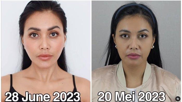 Perubahan wajah Denada setelah operasi plastik.