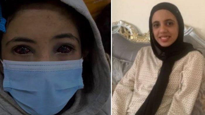 Amina Ghanem (13), dengan mata merah karena menderita pecah pembuluh darah yang mempengaruhi kedua matanya kini dalam kondisi membaik.