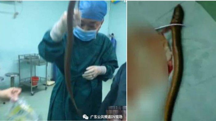 Belut masuk dan berenang dalam perut pria asal China