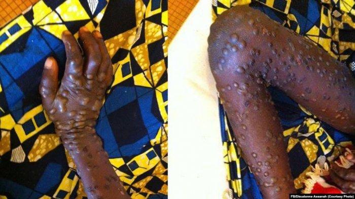 Cacar monyet merebak di Bakouma di bagian timur Afrika Tengah