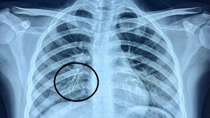 Team dokter Paru Intervensi RSUDZA Banda Aceh didampingi oleh dokter anestesi dan perawat ahli berhasil mengambil jarum pentul yang bersarang di paru pasien, Kamis (3/8/2023)