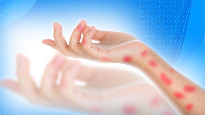 Mudah Menular, 116 Warga Ambon Terdeteksi Penyakit Kusta, 26 di