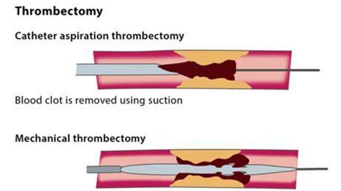 Ilustrasi prosedur Trombektomi