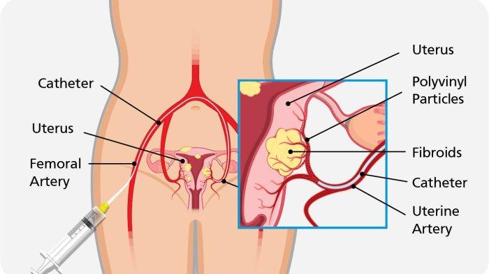 Opsi Perawatan Mioma Uterus Non-Operasi