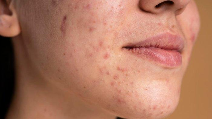 Ilustrasi - 6 Arti Mimpi Tentang Jerawat, Termasuk Kesempatan Akan Terbuka