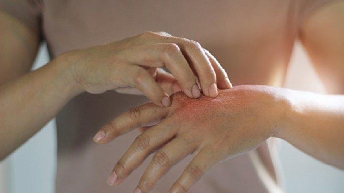 Penyebab Kulit Kering Saat Fungsi Ginjal Terganggu, Kenali Sebabnya!