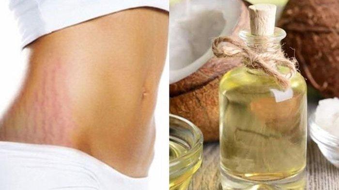 Stretch Mark dengan Minyak Kelapa