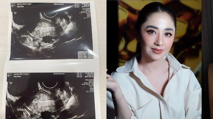 Dewi Perssik unggah hasil foto USG buktikan tak mandul.