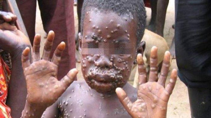 Kondisi bocah Afrika yang badannya terserang virus cacar monyet atau monkeypox.