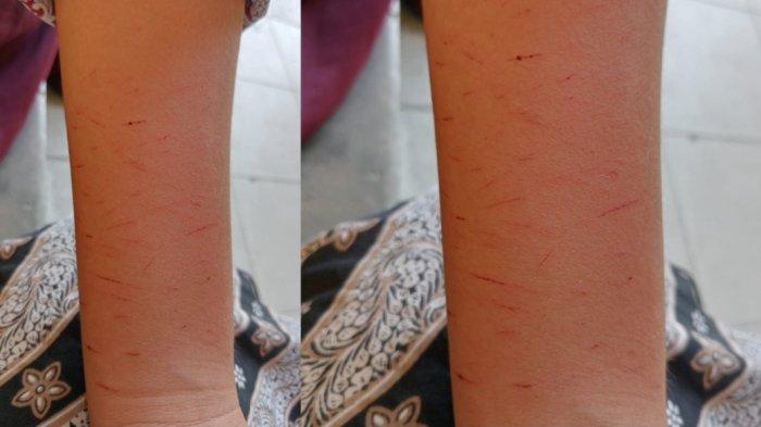 Potret tangan salah satu siswa SD di Kabupaten Serang yang tampak disayat-sayat kecil tak beraturan.
 