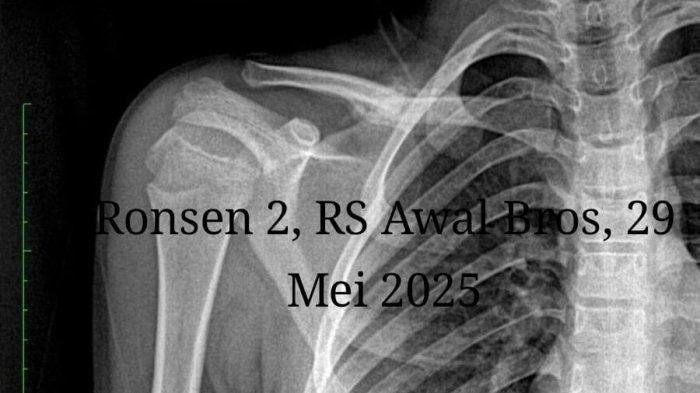 SISWA MTS DIANIAYA - Orang tua siswa MTsN Batam memperlihatkan hasil rontgen terbaru, tulang bahu korban bergeser. 