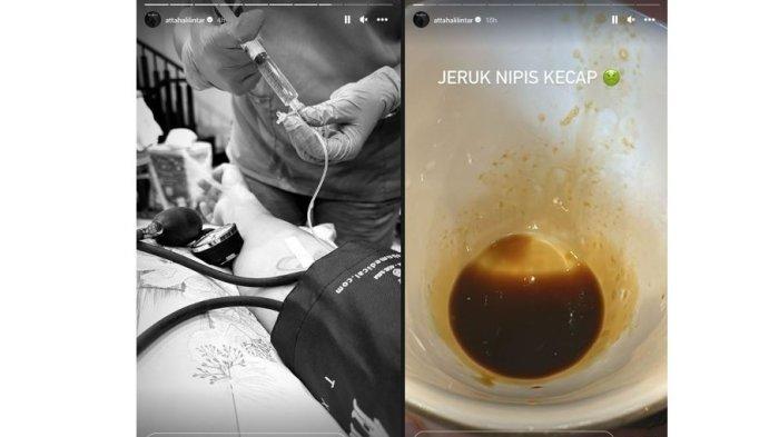 Tangan Atta Halilintar daiinfus setelah minum kecap dicampur jeruk nipis, Kamis (14/12/2023).