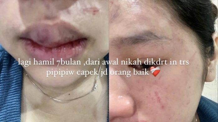 KORBAN KDRT - Seorang perempuan hamil berinisial FS mengalami kekerasan dalam rumah tangga (KDRT) oleh sumainya di Bogor.