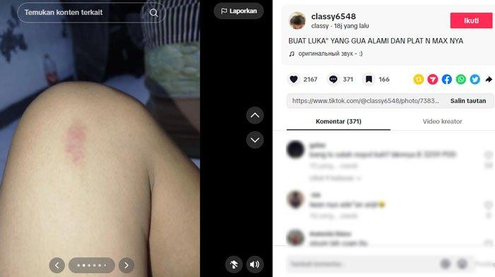 Bocah yang tantang driver ojol ternyata dapat banyak luka usai dianiaya driver ojol hingga kaki, tangan dan lehernya memar.