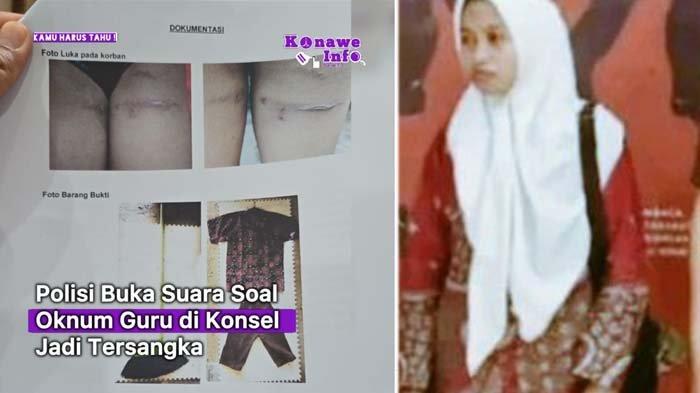 Penampakan luka di paha korban yang diduga diakibatkan karena pemukulan dari guru honorer Supriyani.