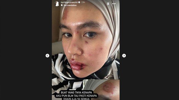 Curhat pilu artis sekaligus istri Habib Usman, Kartika Putri yang tiba-tiba mengidap penyakit misterius. Wajah dan lidah artis yang karib disapa Karput itu tiba-tiba melepuh
