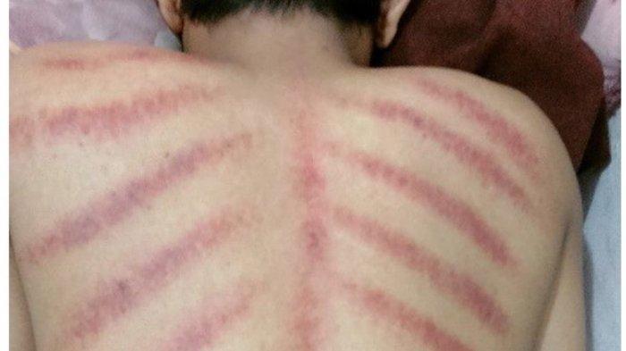 Manfaat kerokan selain untuk mengatasi masuk angin