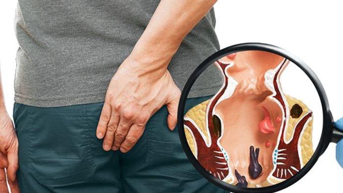 ilustrasi seseorang yang mengalami ambeien