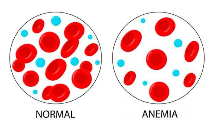 Ilustrasi anak yang alami anemia, berikut kenali penyebabnya