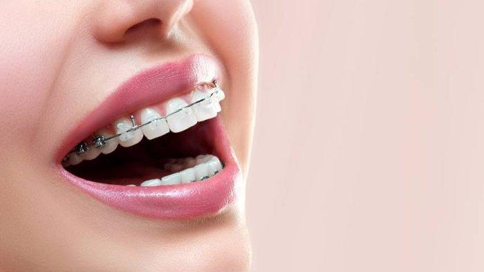 ilustrasi penggunaan behel atau kawat gigi